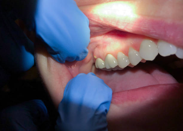 Best Dental Abscess Treatment in Hurricane, WV